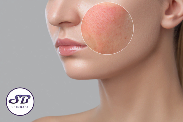 Can You Over-Exfoliate Skin?