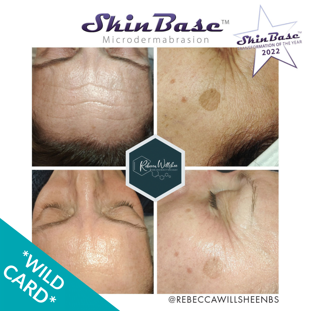 Microdermabrasion for pigmentation and wrinkles