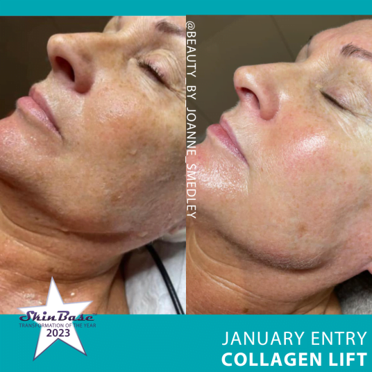 COLLAGEN LIFT TRANSFORMATIONS BEAUTYBYJOANNESMEDLEY