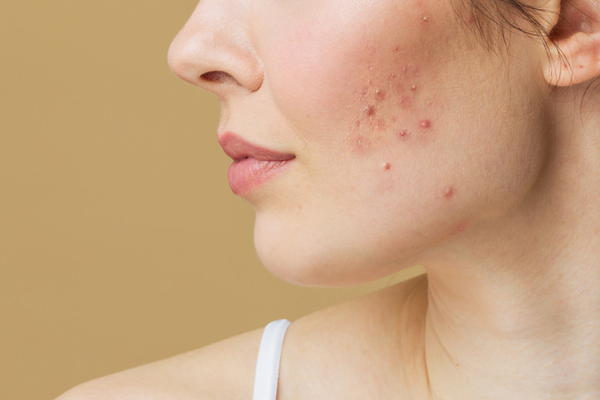 is-your-acne-hormonal-or-bacterial