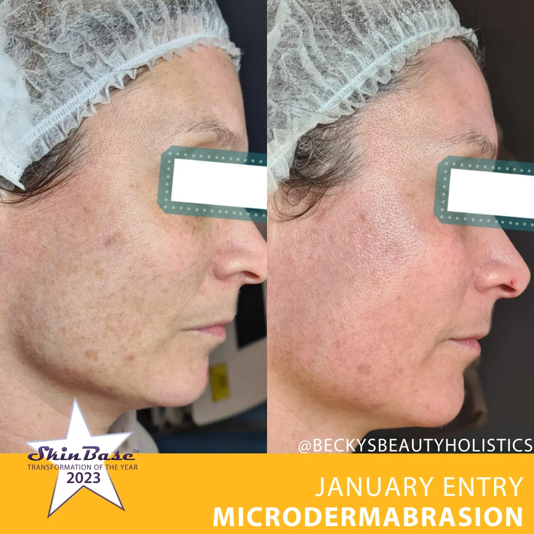 Microdermabrasion Before & After | SkinBase