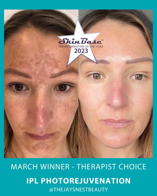 March winner Melasma pigmentation transformation before and after