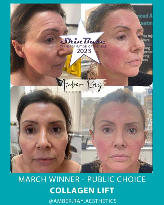 March Winner skin laxity, fine lines and wrinkles transformation