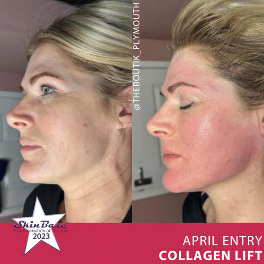April transformation entries collagen lift facial sculpting