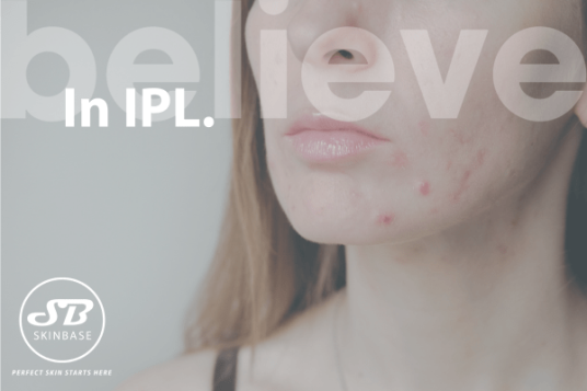 IPL for Acne