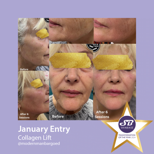 January collagen lift entries