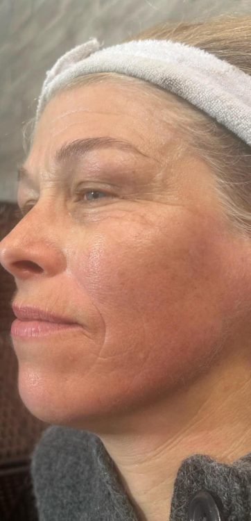 beforeandaftercollagenlift