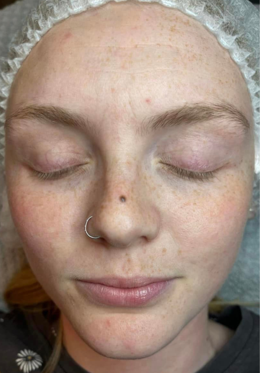 What is Microdermabrasion - SkinBase™(Europe) Ltd