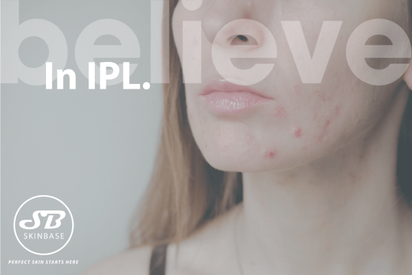 Treating Skin Concerns: IPL for Acne