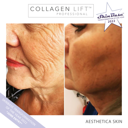 Must See Collagen Lift Transformation