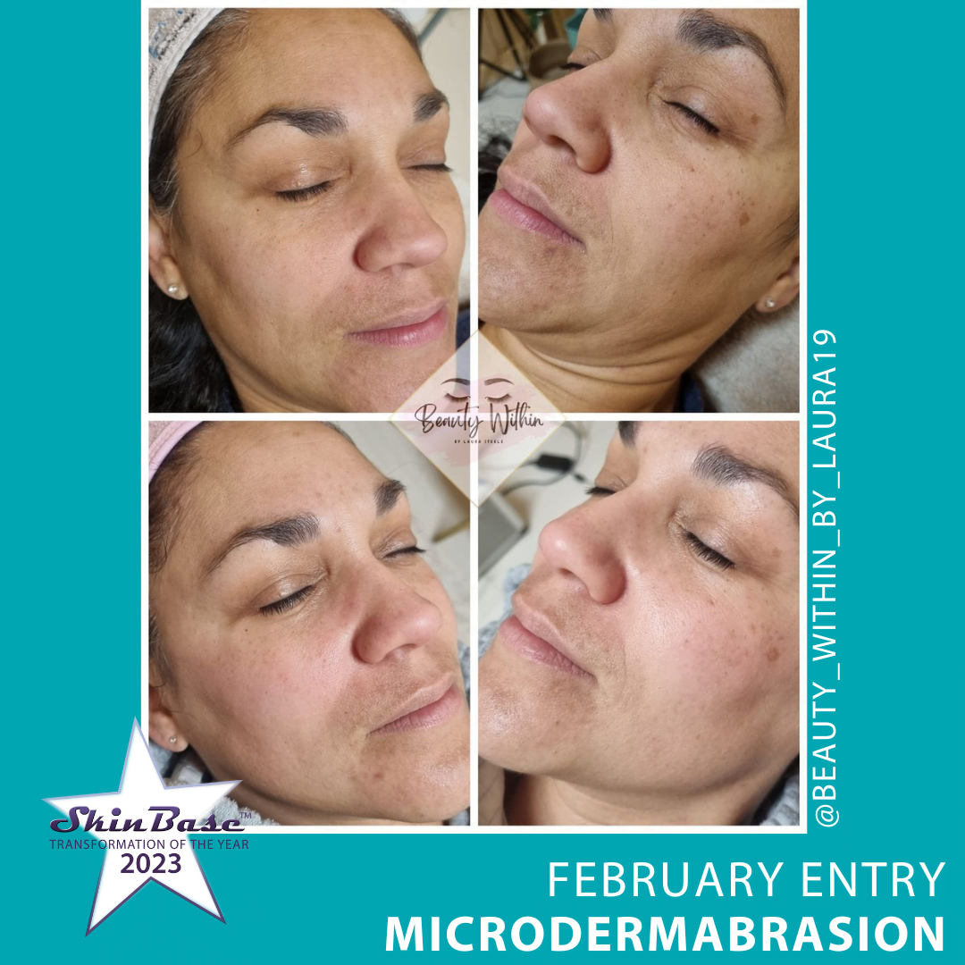 Microdermabrasion before and after