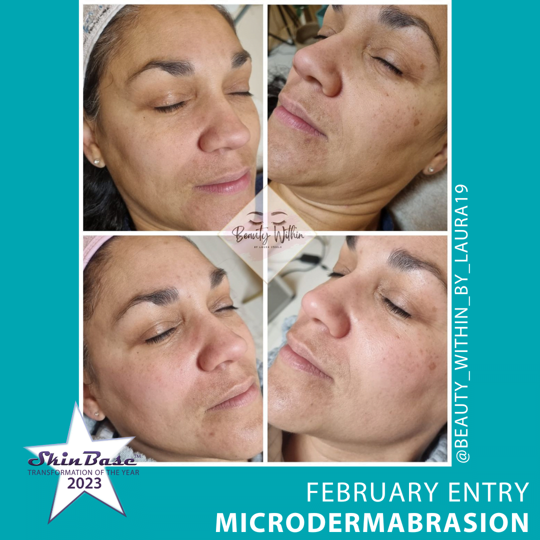 February voting - microdermabrasion for 'pregnancy mask' melasma pigmentation