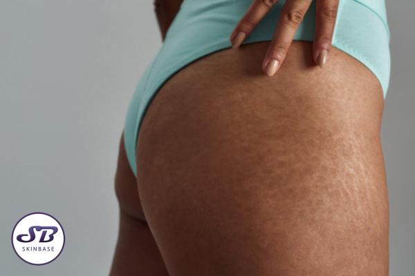 How to Get Rid of Stretch Marks: The 4 Best Treatments