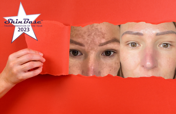 SkinBase IPL Melasma Transformation