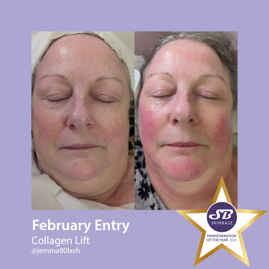 February Collagen Lift transformations Hollywood beauty