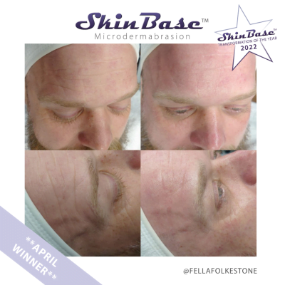 microdermabrasion before and after