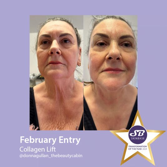 February Collagen Lift transformations the beauty cabin