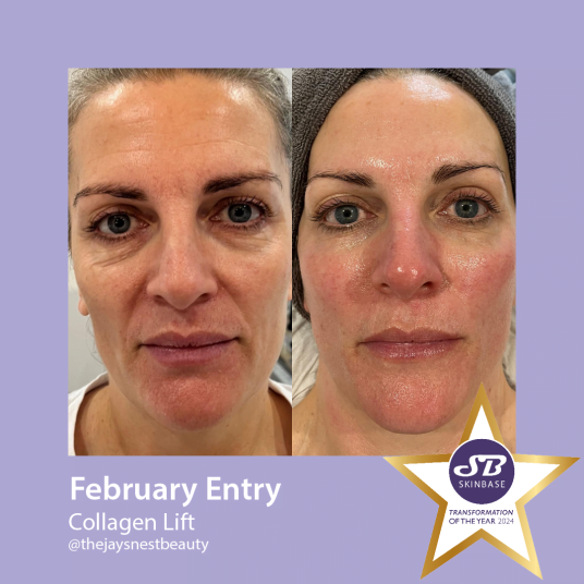 February Collagen Lift transformations the jays nest