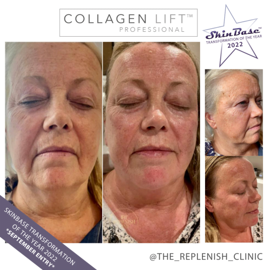 The Replenish Clinic Collagen Lift Before and After