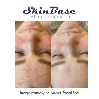 microdermabrasion before and after