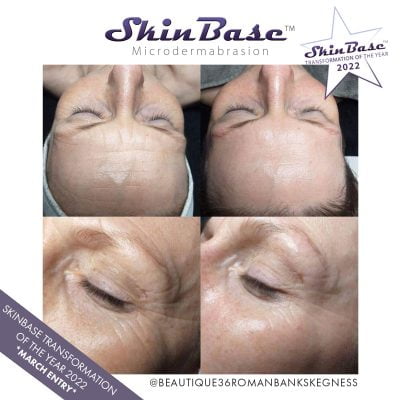 microdermabrasion before and after