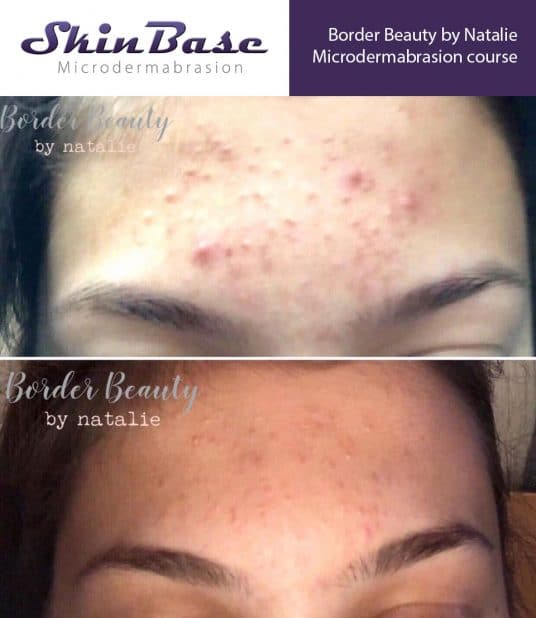 Microdermabrasion for spots – See the results