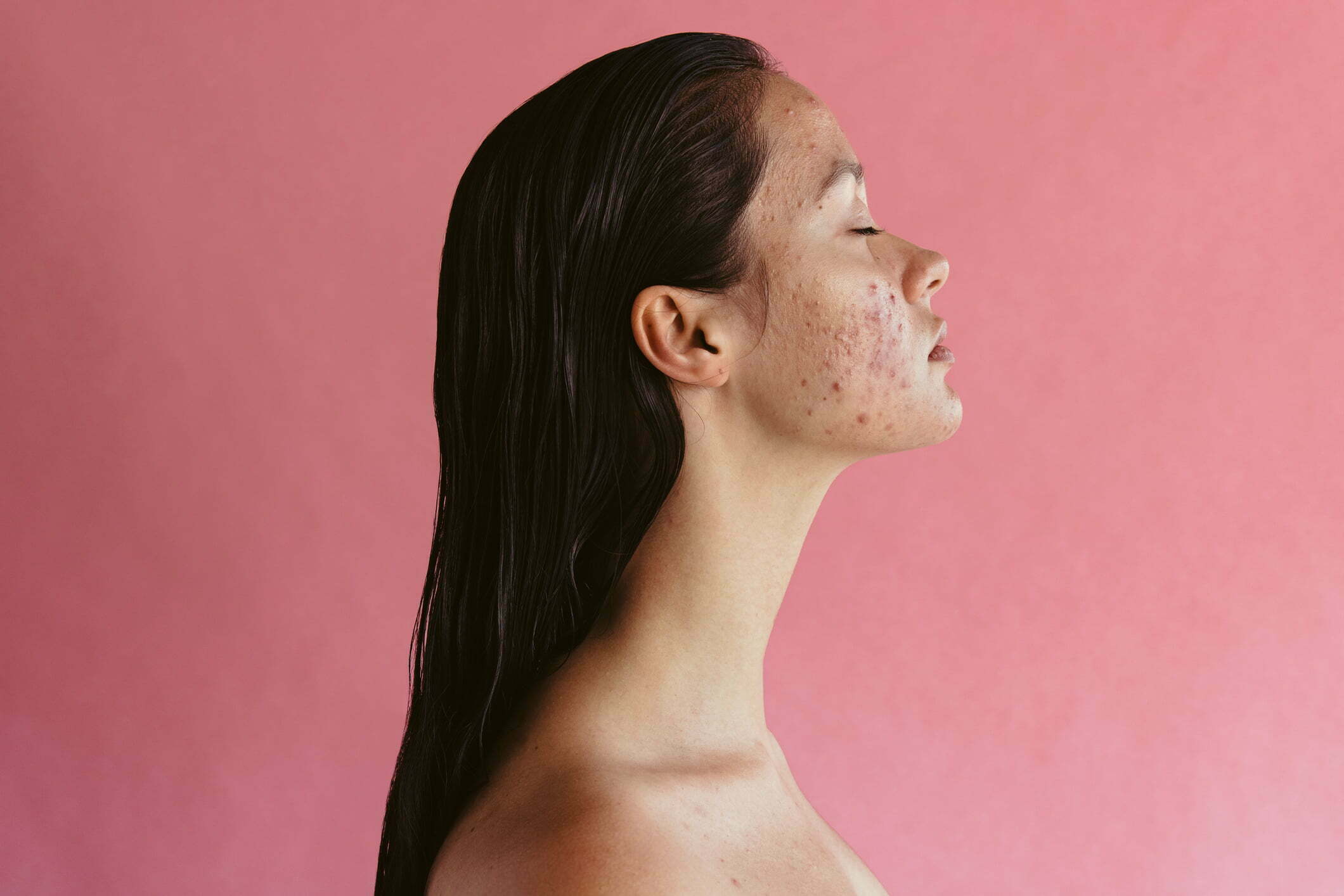 Active acne discount