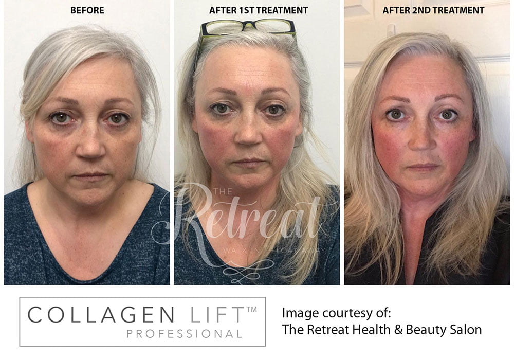 Collagen Lift results – Be warned, you’re going to want this treatment!