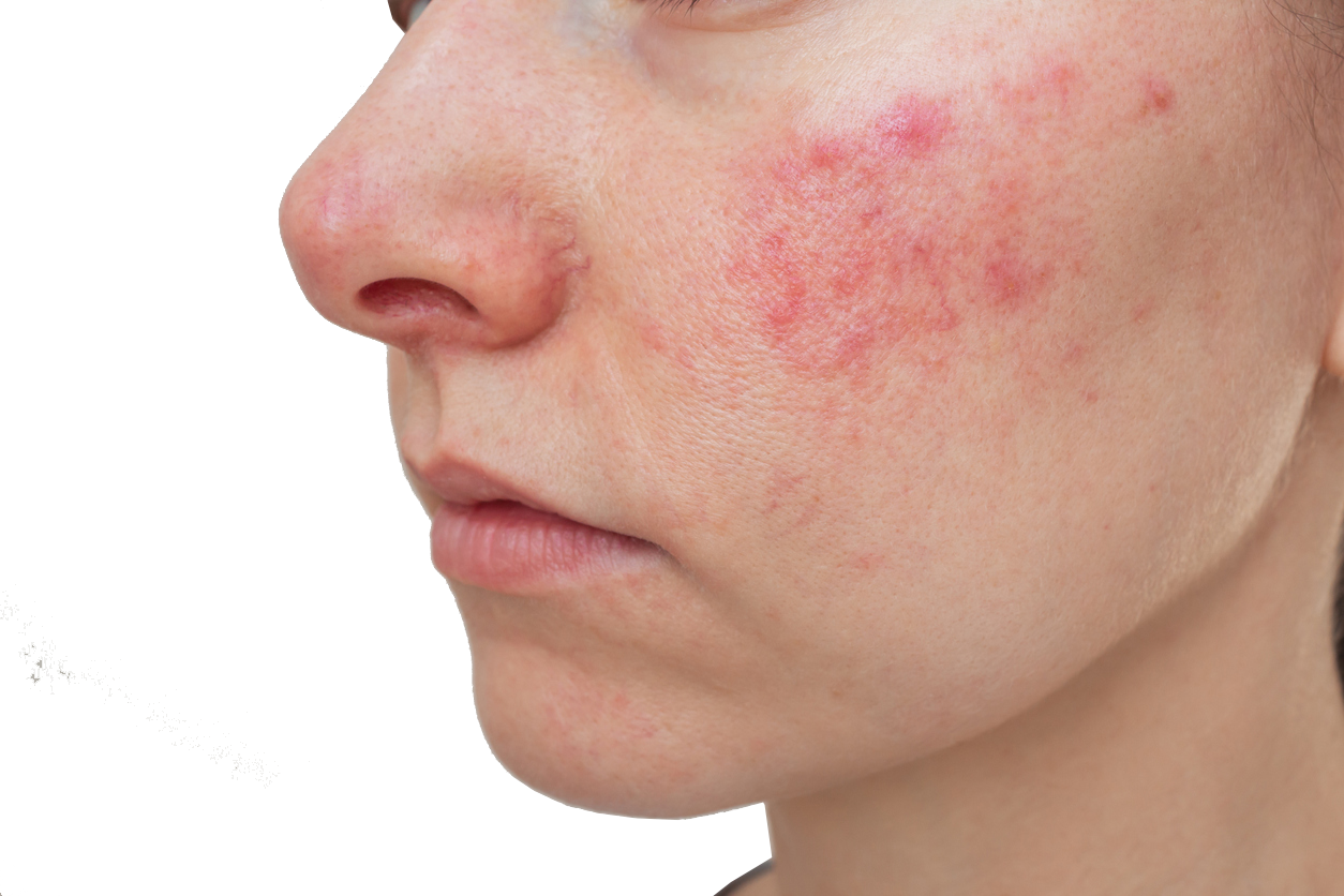 Rosacea How To Improve And Maintain Your Skin s Health SkinBase 