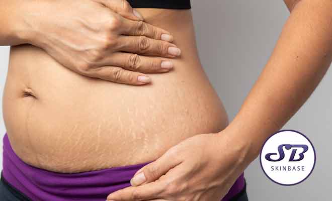 How to improve the appearance of stretch marks