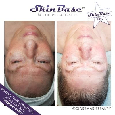 microdermabrasion before and after