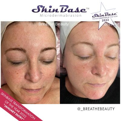 microdermabrasion before and after