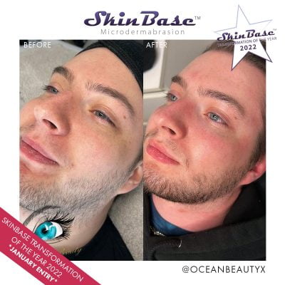 microdermabrasion before and after