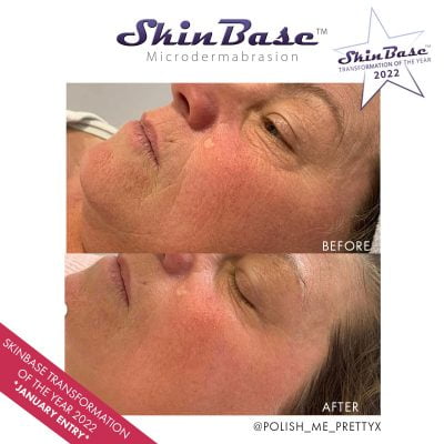 microdermabrasion before and after