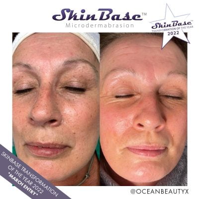 microdermabrasion before and after