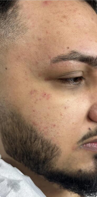 before and after microdermabrasion blondie hair and beauty
