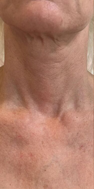 before and after collagen lift Katherine Monique Beauty
