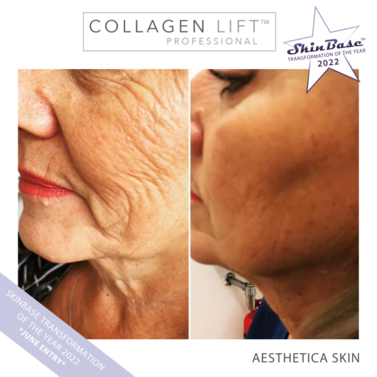 Must See Collagen Lift Transformation