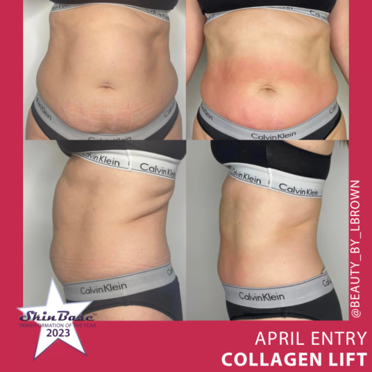 April transformation entries radio frequency tummy transformation 