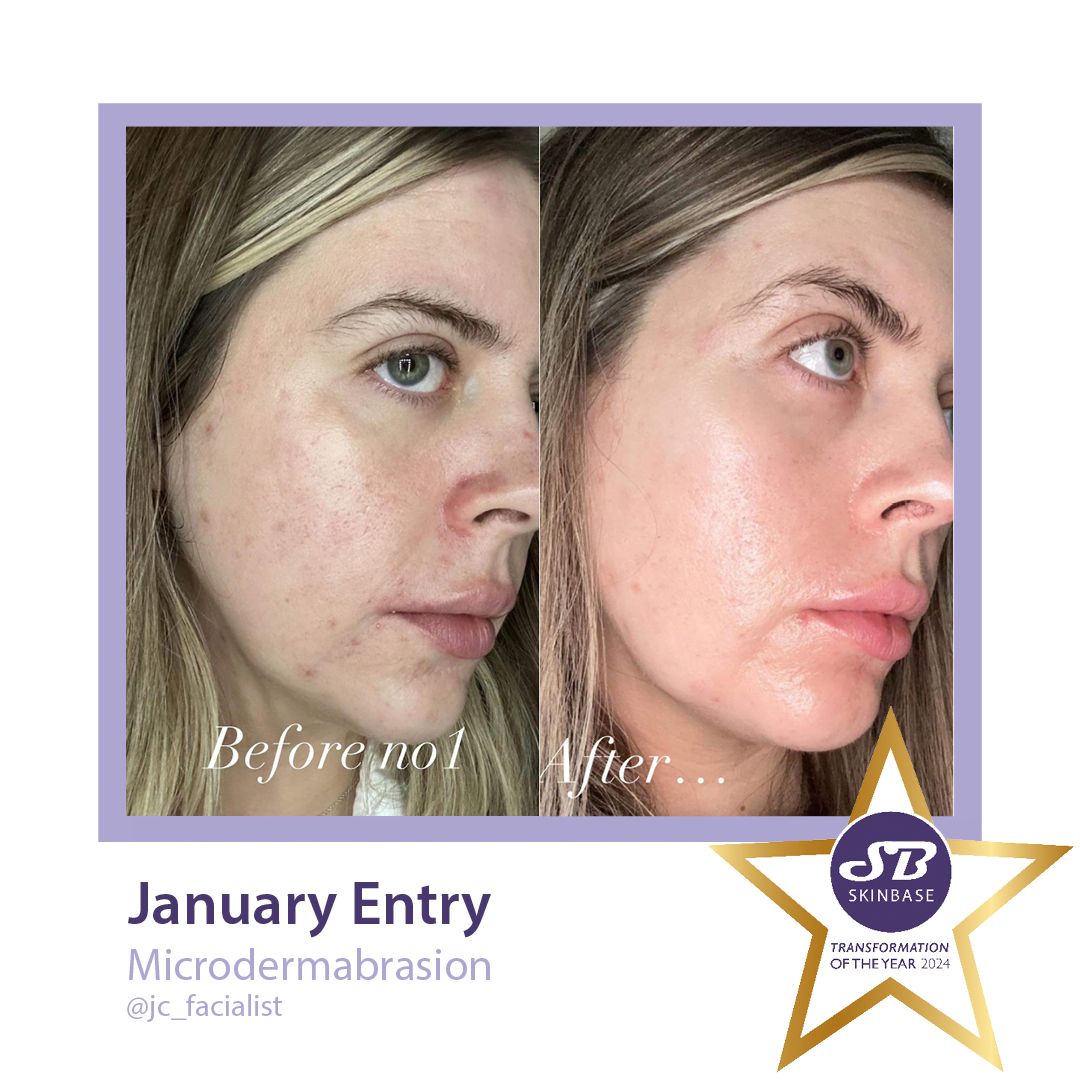 Microdermabrasion before and after