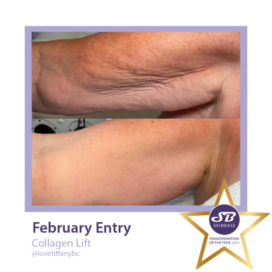 February Collagen Lift transformations love Tiffany