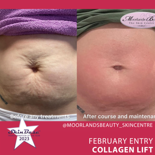 February voting - Before and After Collagen Lift for skin laxity and stretch marks