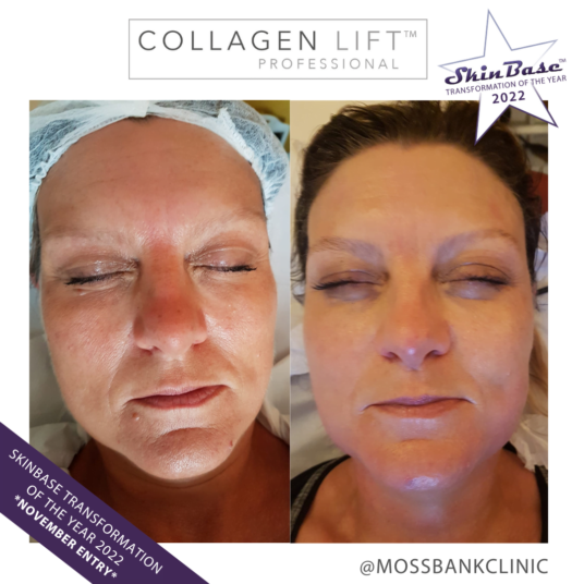 winter collagen lift transformation