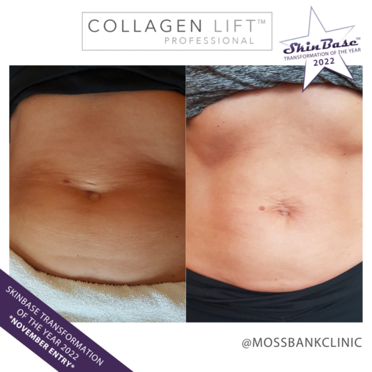 collagen lift body transformation