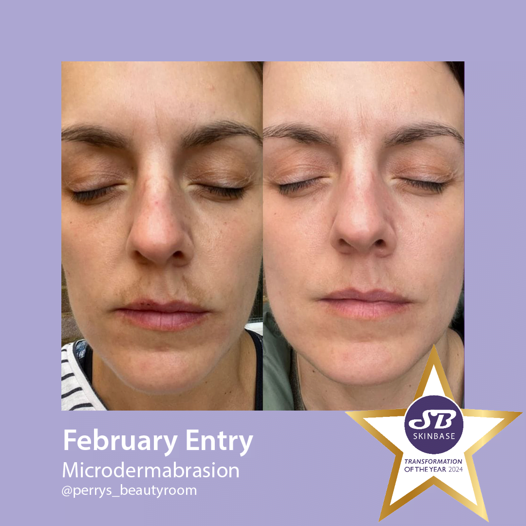 Microdermabrasion for pigmentation