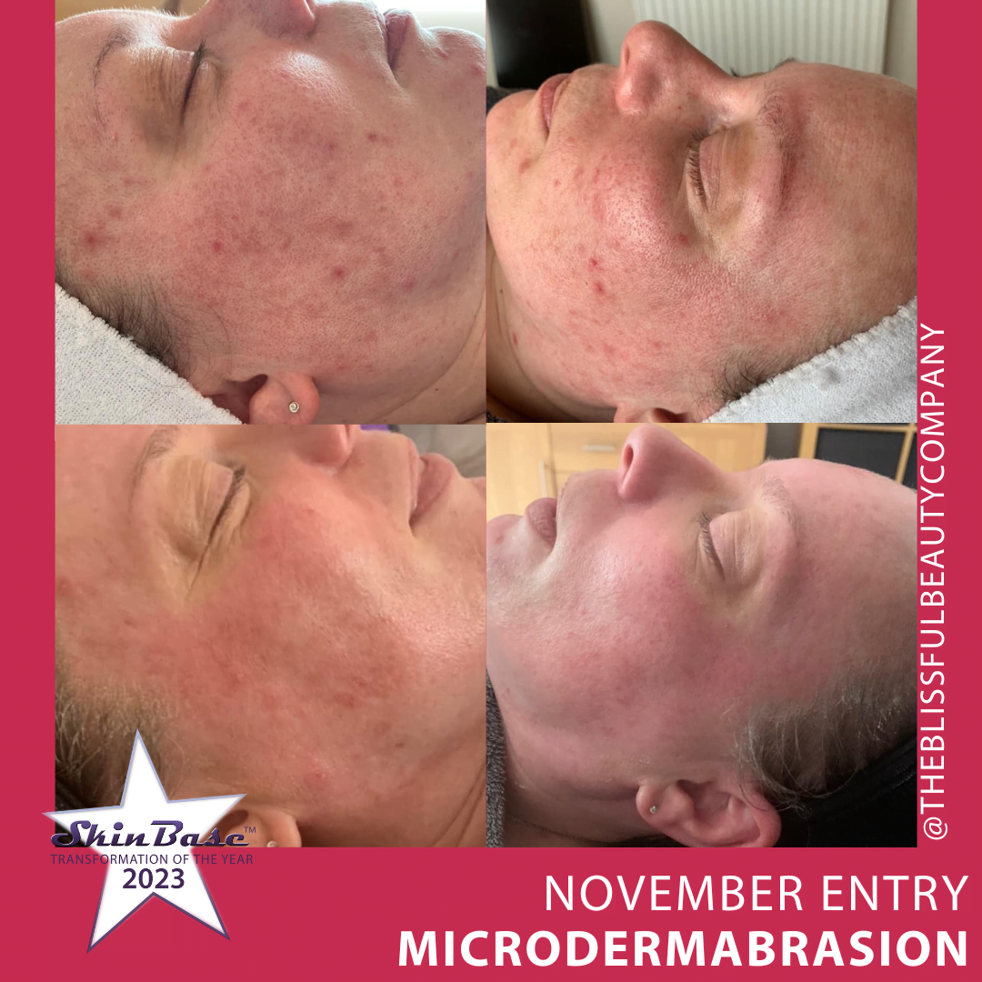Microdermabrasion before and after