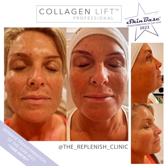 Must See Collagen Lift Transformation