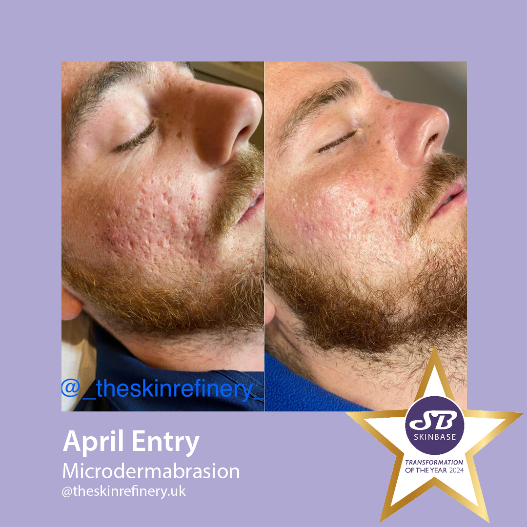 Before and after microdermabrasion for acne