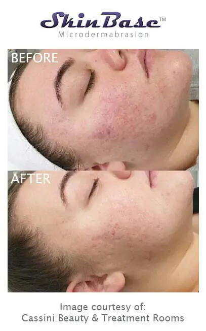 acne scarring