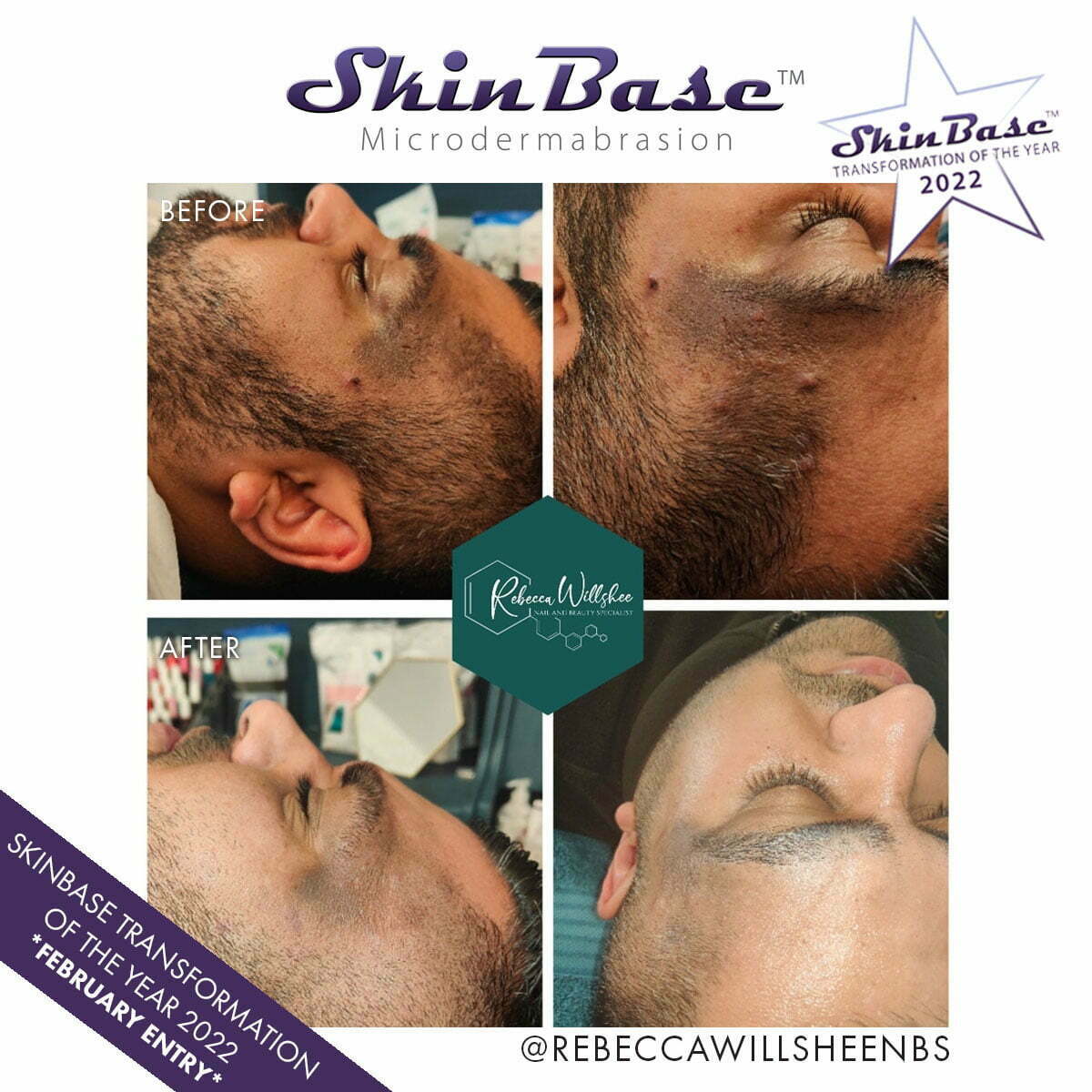 Rebecca wilshee Microdermabrasion